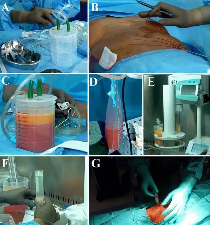 Knee SVF Procedure
