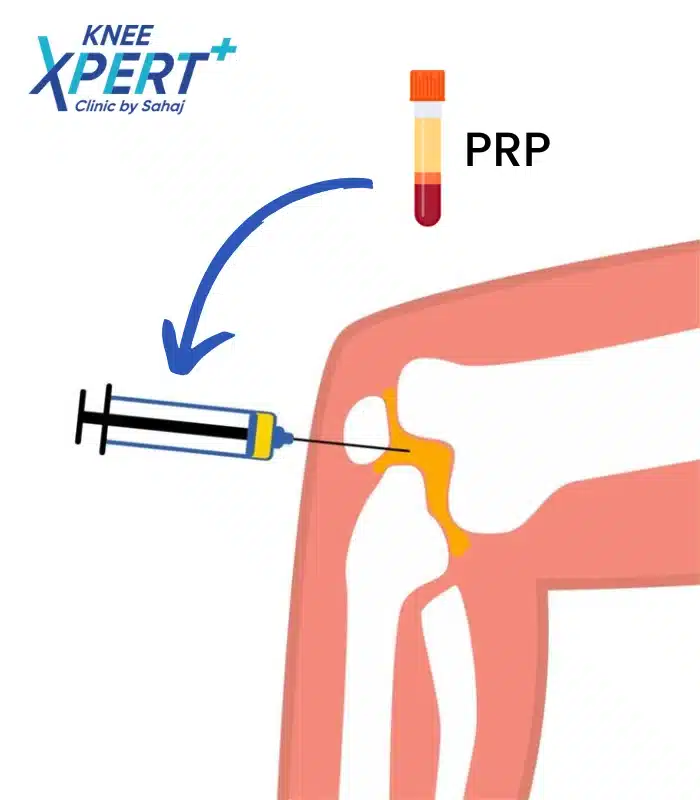 PRP